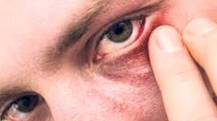 स्वास्थ्य मन्त्रालयले भन्यो- ‘आँखा पाक्ने रोगबाट आत्तिनु पदैन’, यस्ता छन् बच्ने उपाय